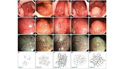 Классификация микрососудов носоглотки, выявляемых при узкоспектральной эндоскопии, и их роль в диагностике рака носоглотки